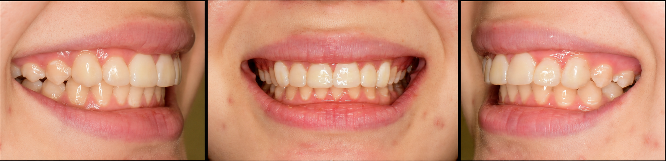Veneer after front, left side, and right side view image