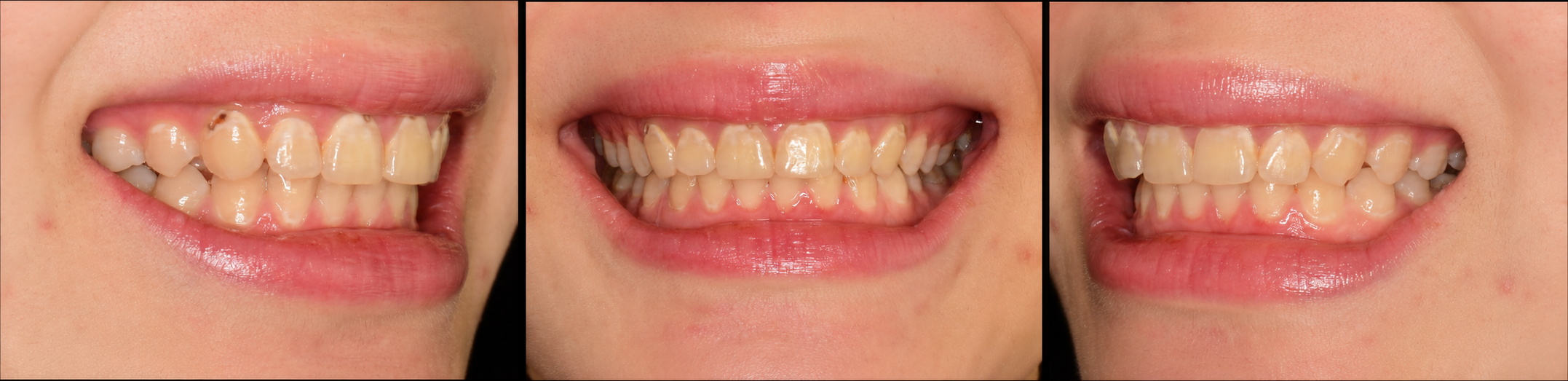 Veneer before front, left side, and right side view image