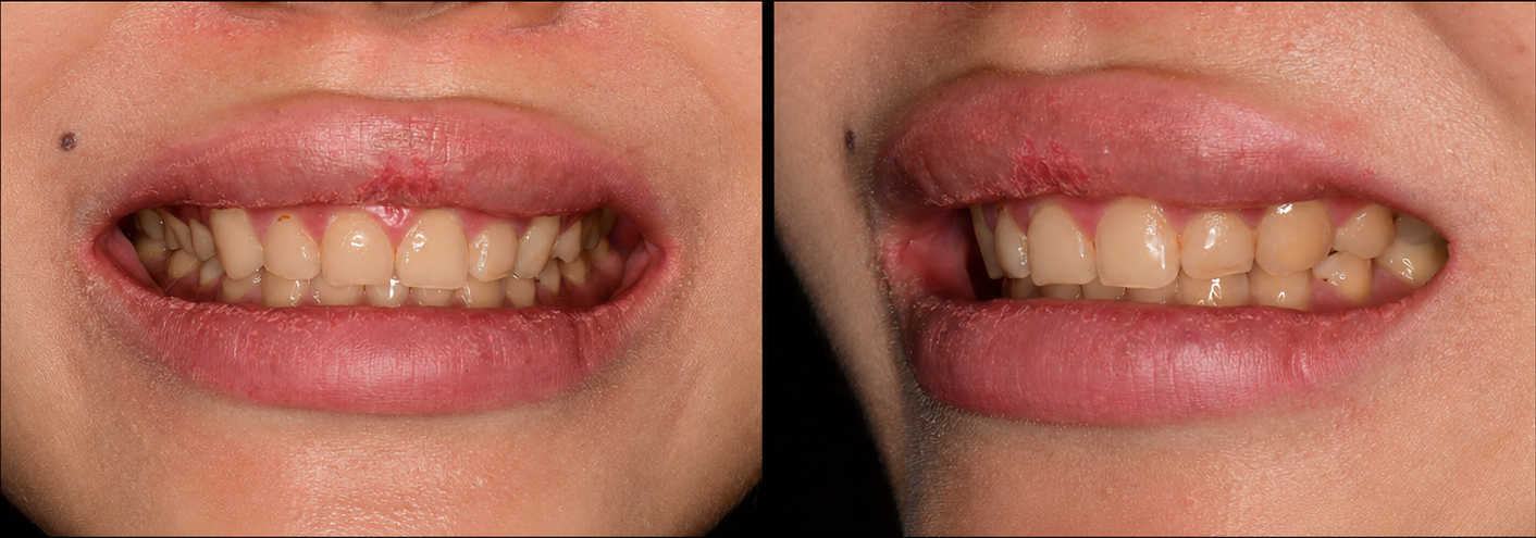 Veneer before front, left side, and right side view image