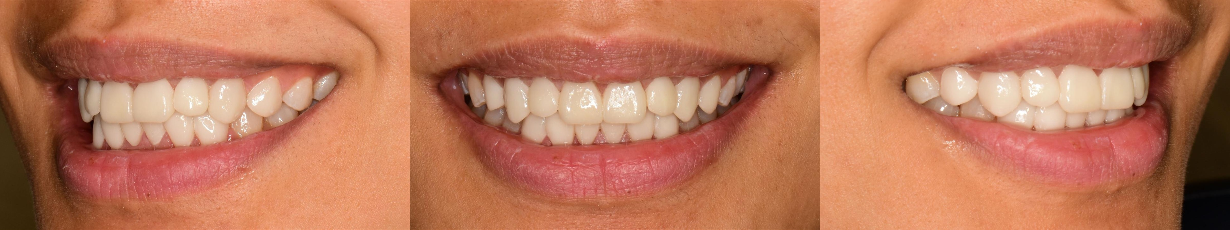 Veneer after front and right side view image