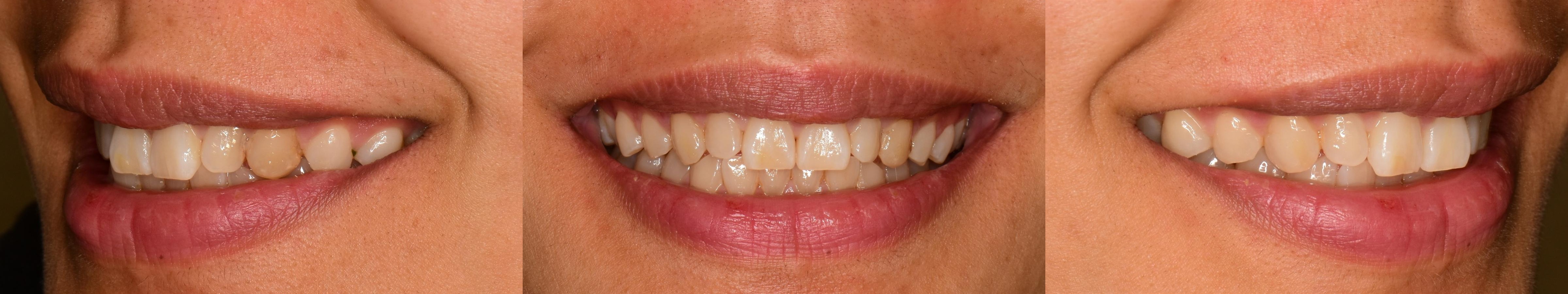 Veneer before front and right side view image