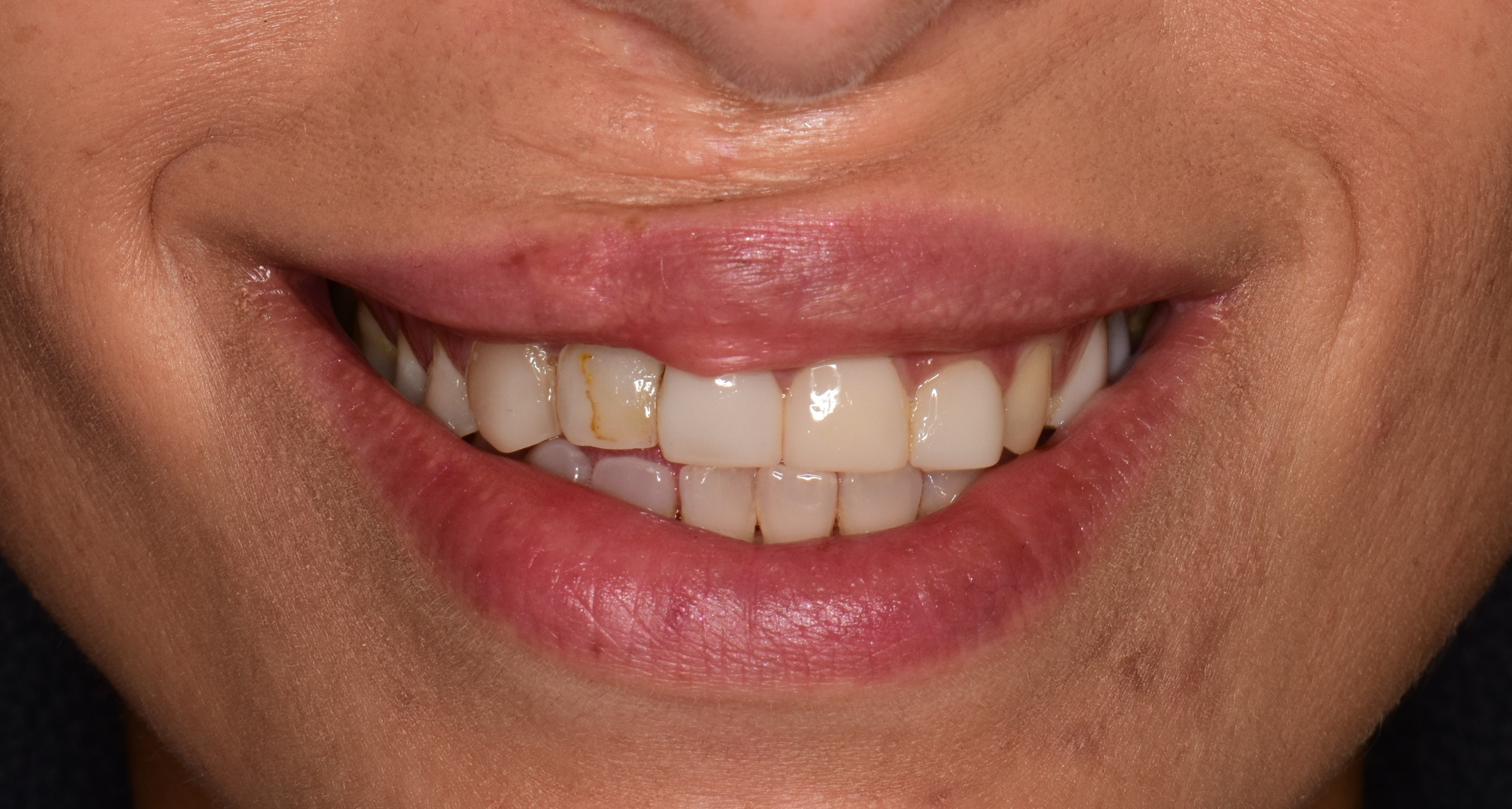 Case 4 before, front view